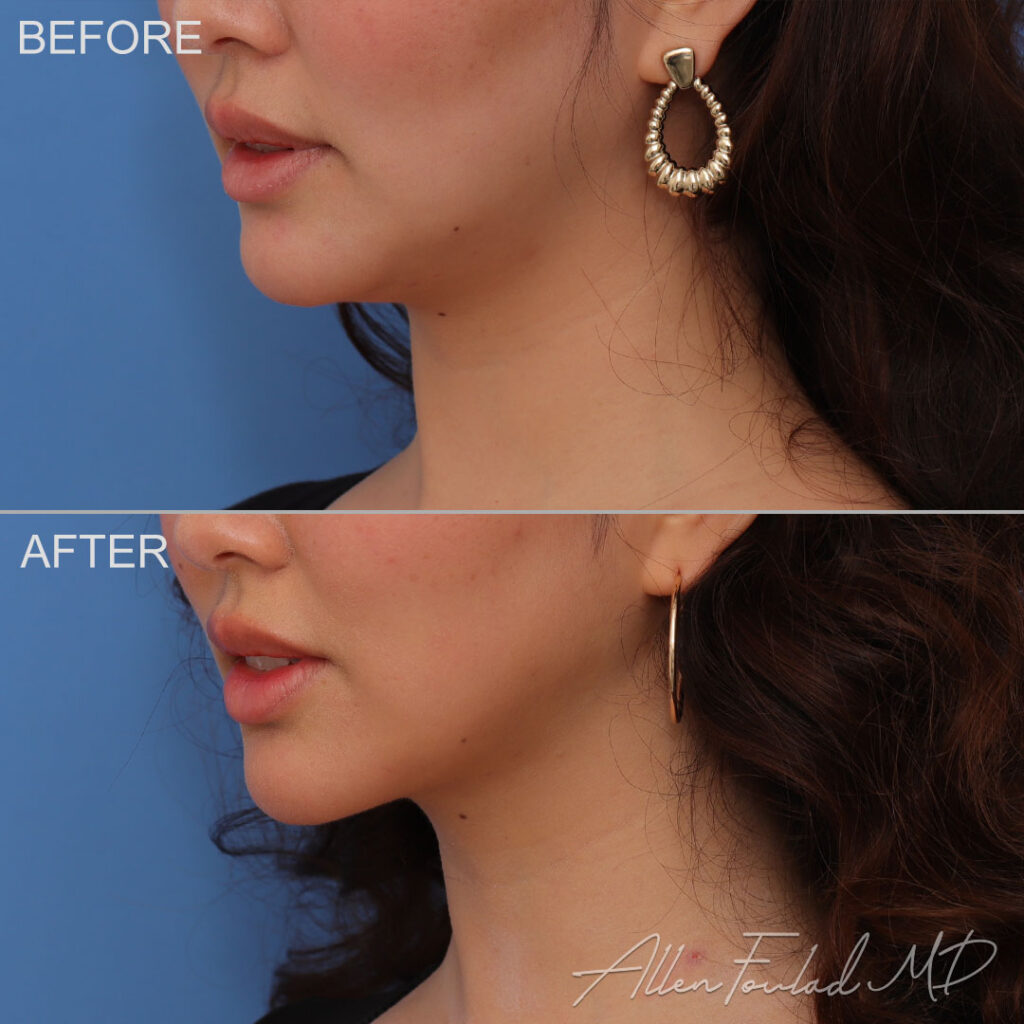 Before and after Liposuction of Face and Neck, on female patient.