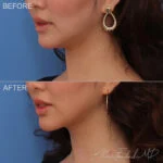 Before & After (id-1053) – Liposuction of Face and Neck