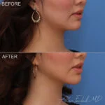 Before & After (id-1053) – Liposuction of Face and Neck
