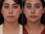 Before & After (id-1054) – Liposuction of Face and Neck