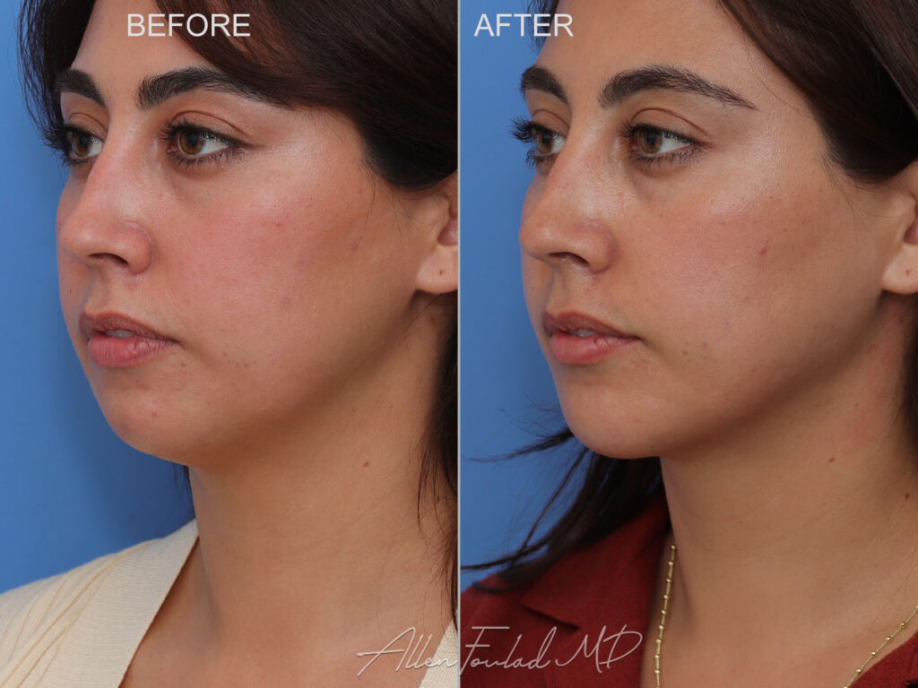 Before and after Liposuction of Face and Neck, on female patient.