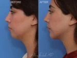Before & After (id-1054) – Liposuction of Face and Neck