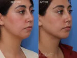 Before & After (id-1054) – Liposuction of Face and Neck