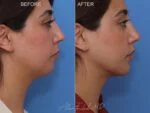 Before & After (id-1054) – Liposuction of Face and Neck