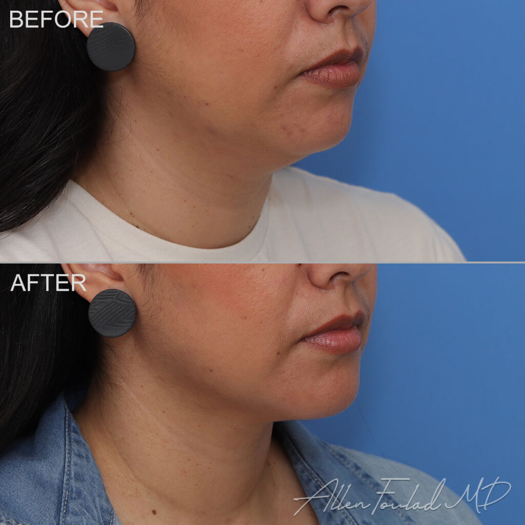 Before and after Liposuction of Face and Neck, on female patient.