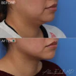 Before & After (id-1058) – Liposuction of Face and Neck