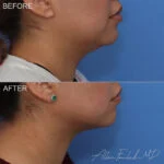 Before & After (id-1058) – Liposuction of Face and Neck