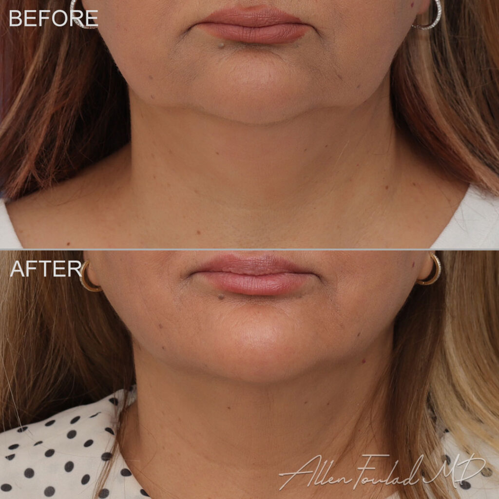 Before & After (id-1059) – Liposuction of Face and Neck Before and after Liposuction of Face and Neck, on female patient.