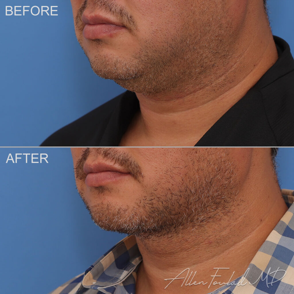 Before & After (id-1060) – Liposuction of Face and Neck Before and after Liposuction of Face and Neck, on male patient.