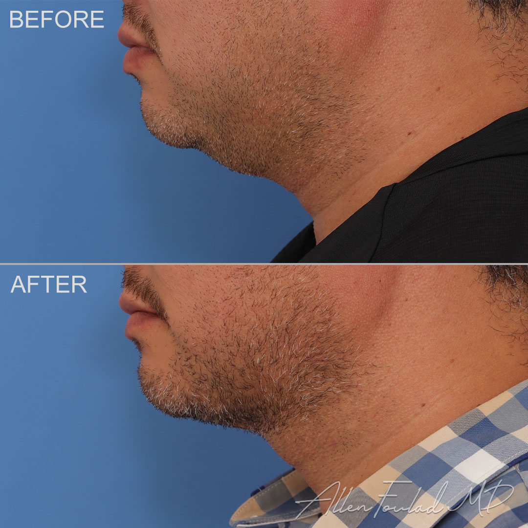 Before and after Liposuction of Face and Neck, on male patient.