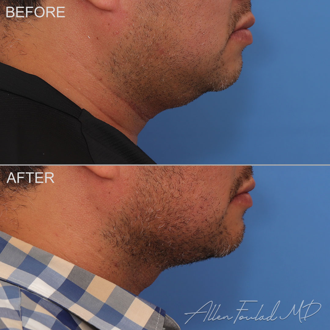 Before and after Liposuction of Face and Neck, on male patient.