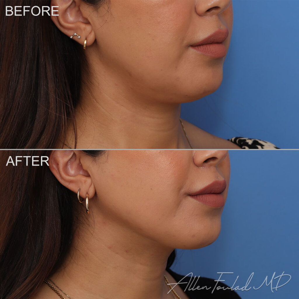 Before and after Liposuction of Face and Neck, on female patient.