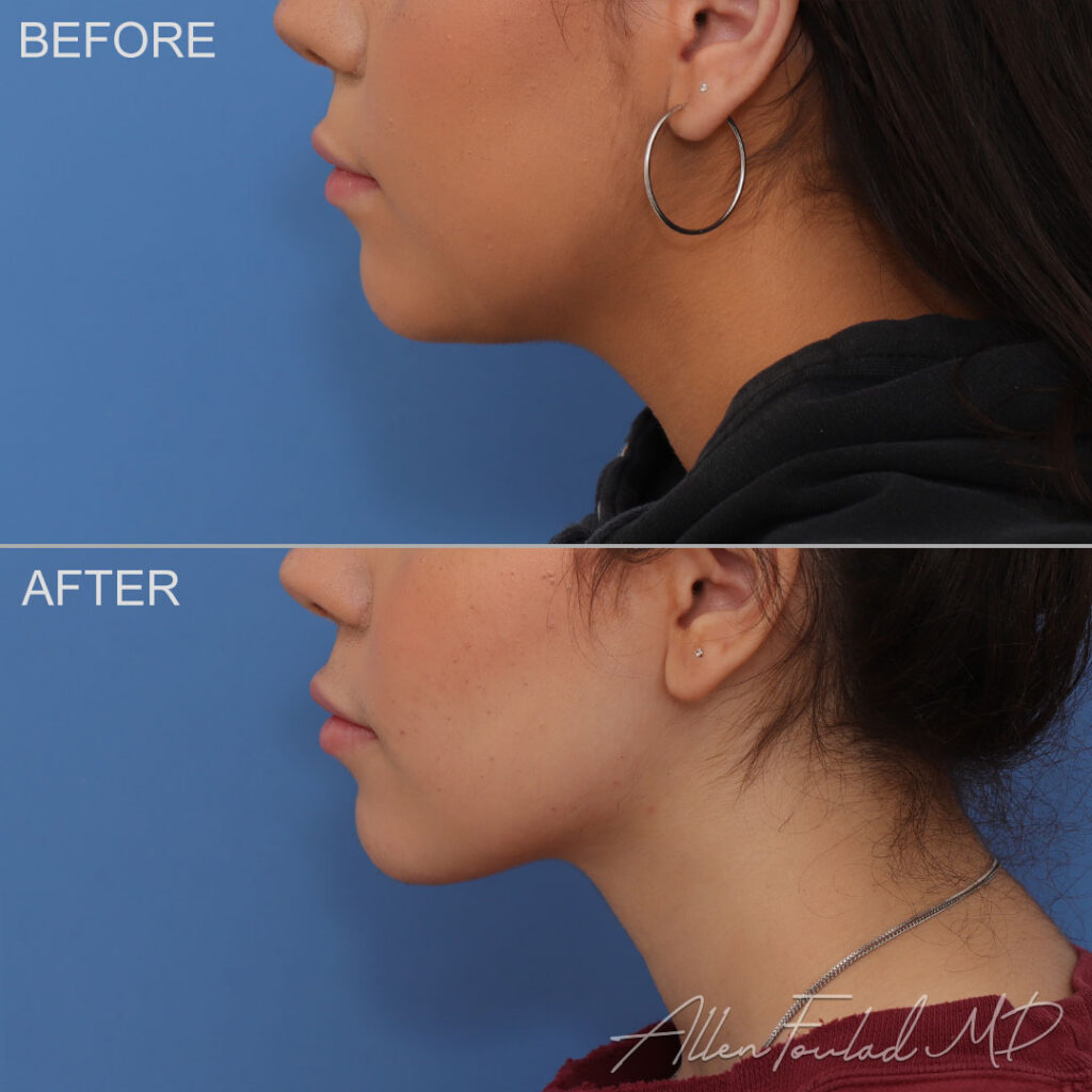 Before & After (id-1062) – Liposuction of Face and Neck Before and after Liposuction of Face and Neck, on female patient.