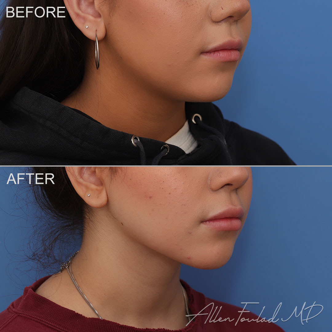 Before and after Liposuction of Face and Neck, on female patient.