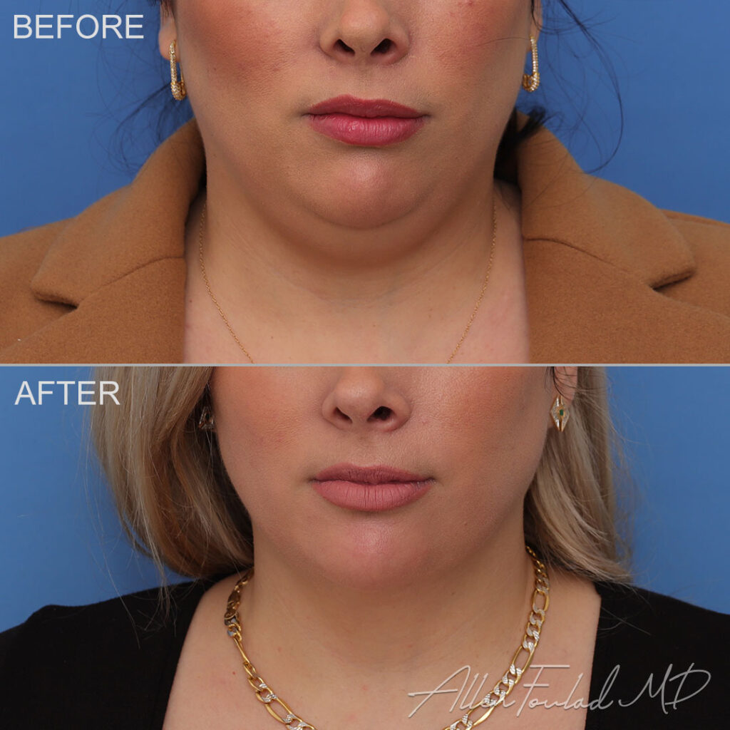 Before and after Liposuction of Face and Neck, on female patient.