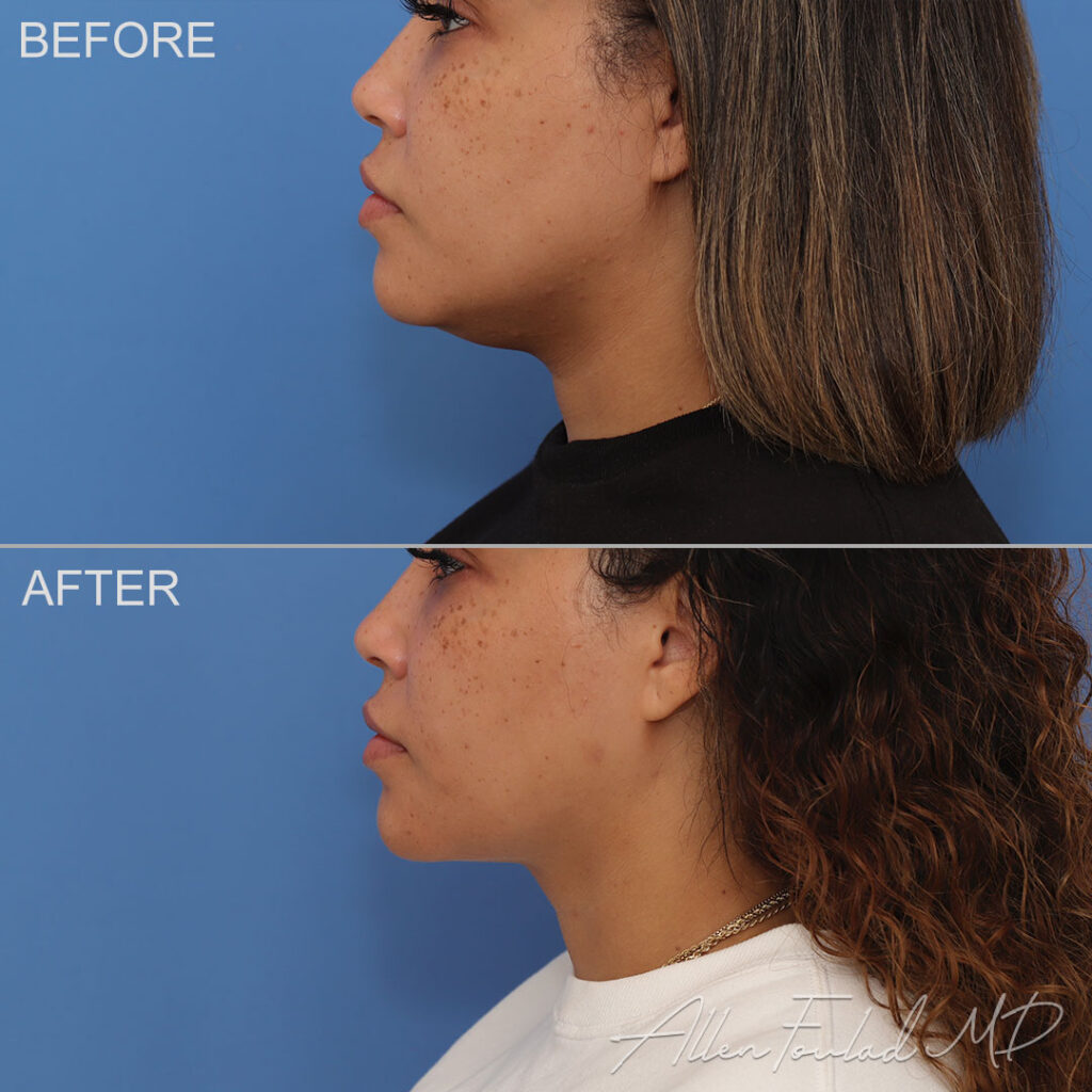 Before and after Liposuction of Face and Neck, on female patient.