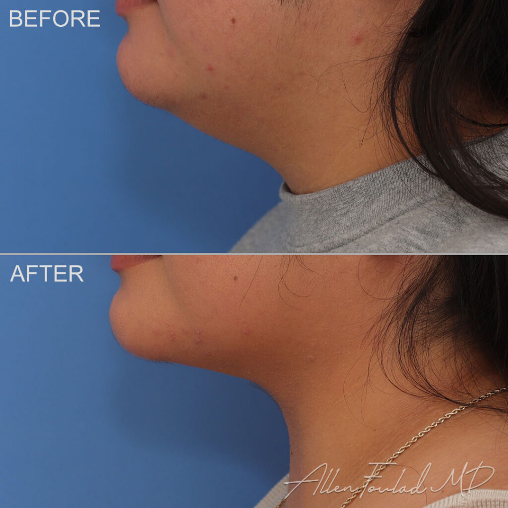 Before & After (id-1049) – Liposuction of Face and Neck Before and after Liposuction of Face and Neck, on female patient.