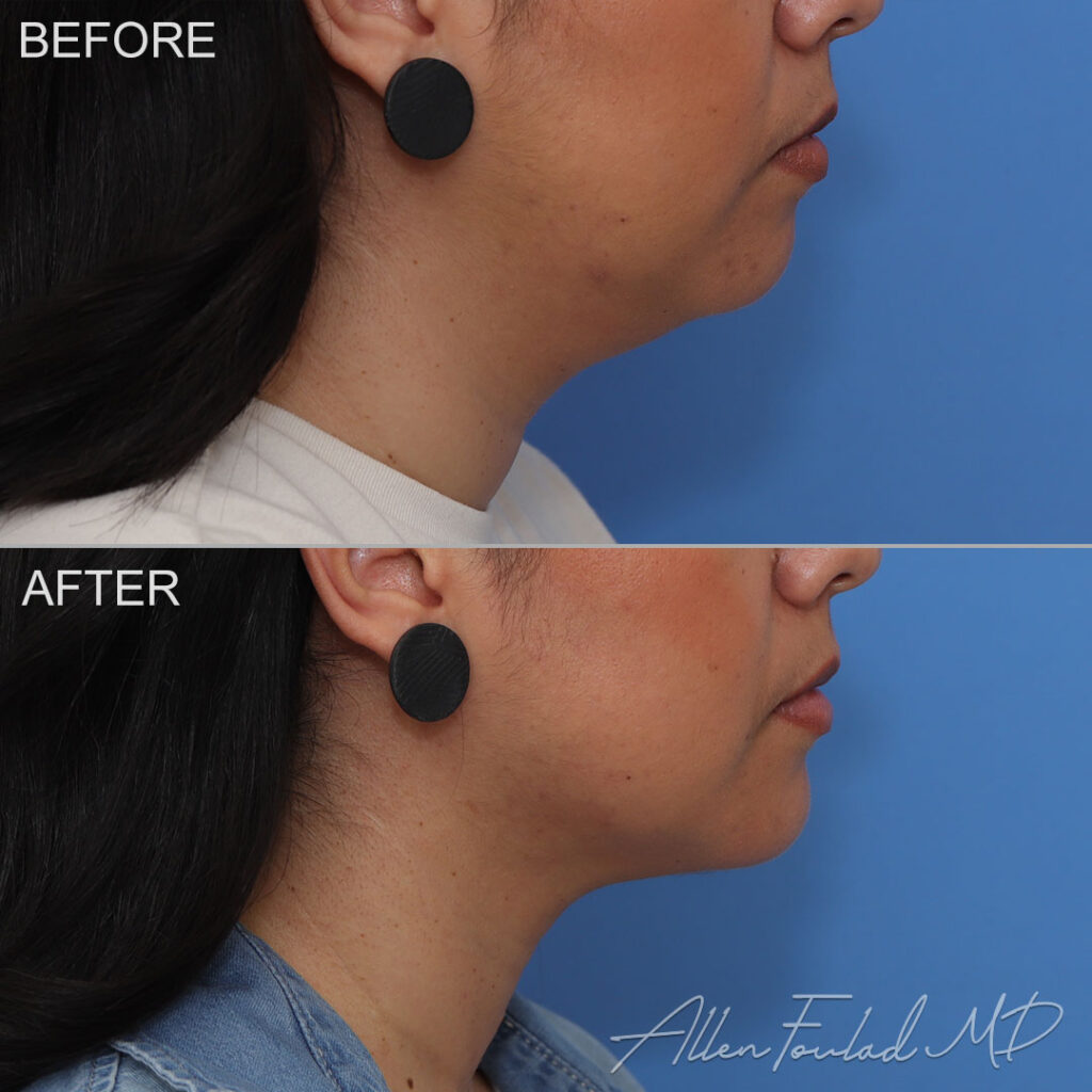 Before and after Chin Implant, on female patient.