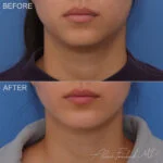 Before & After (id-1073) – Chin Implant