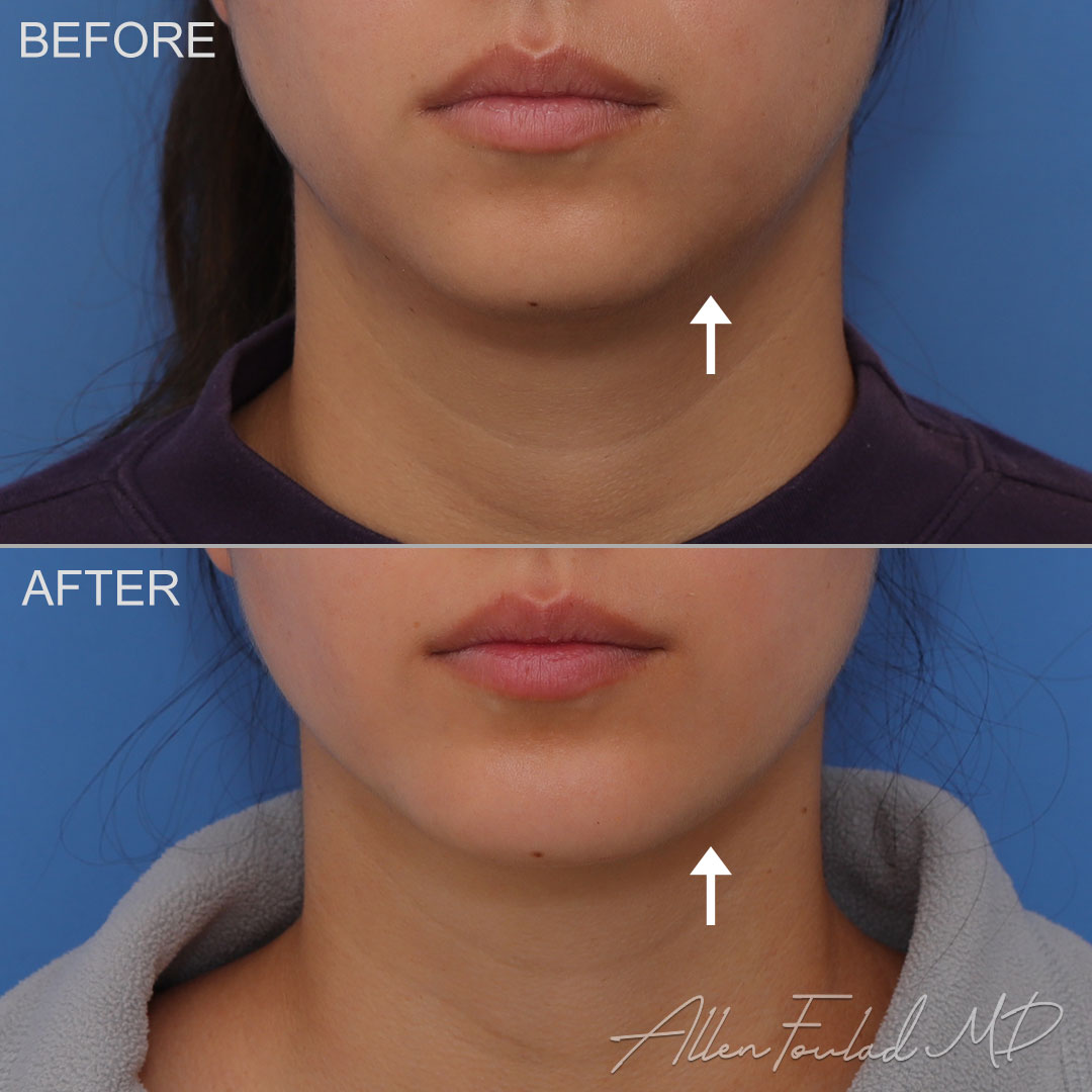 Before and after Chin Implant, on female patient.