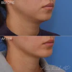 Before & After (id-1073) – Chin Implant