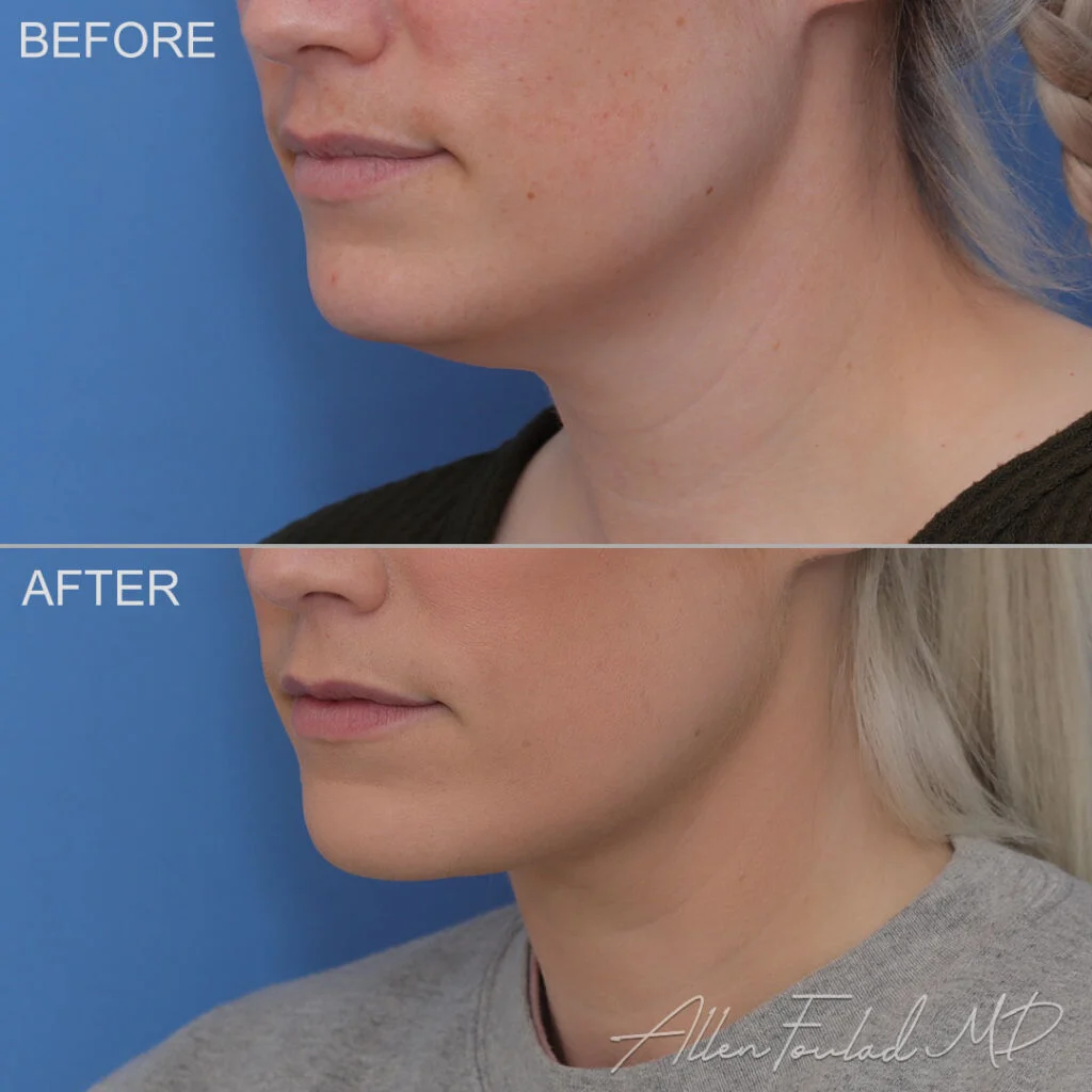 Before & After (id-1075) – MIDS Neck Lift Before and after Minimal Incision Deep Sculpting Neck Lift, on female patient