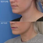 Before & After (id-1075) – MIDS Neck Lift
