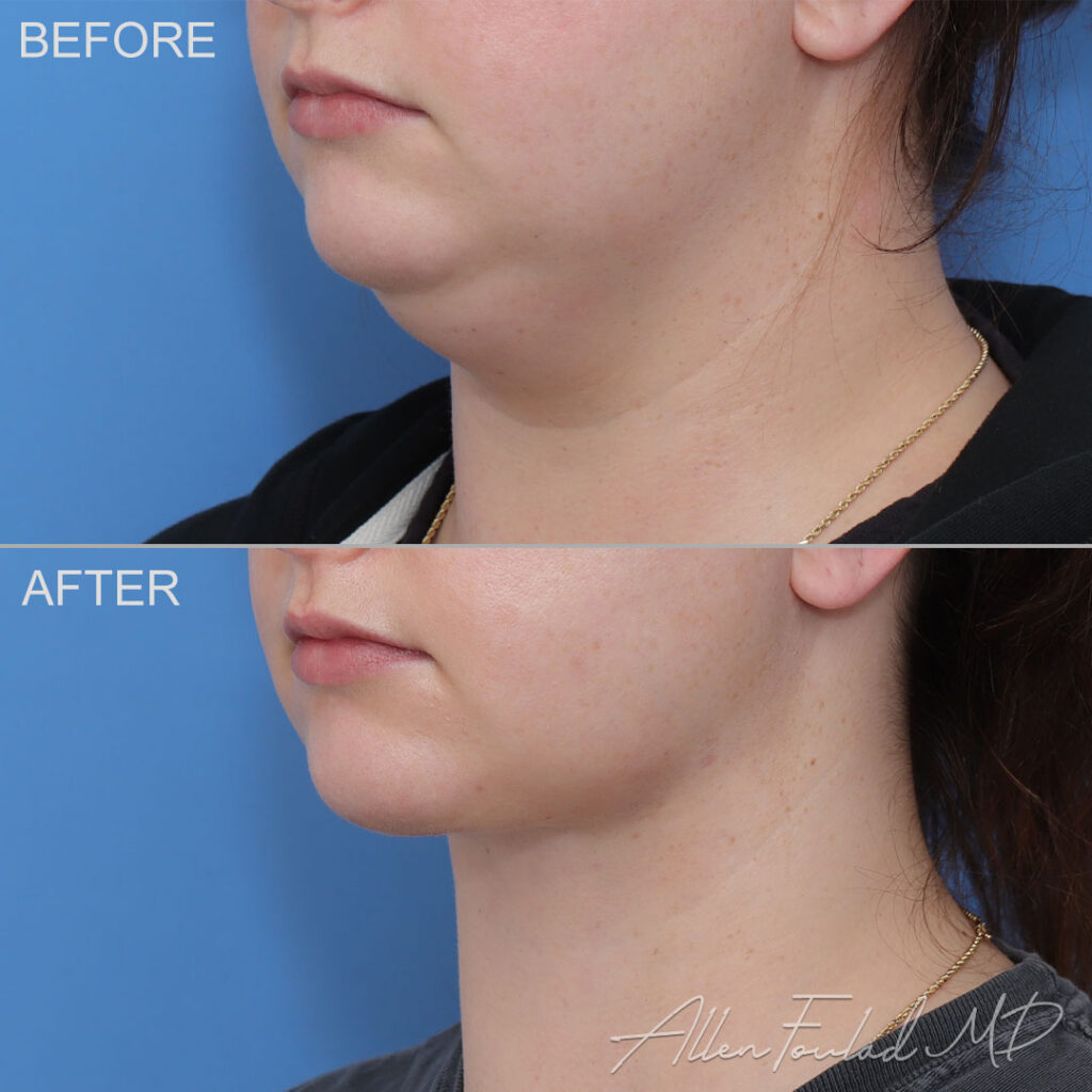 Before & After (id-1077) – MIDS Neck Lift Before and after Minimal Incision Deep Sculpting Neck Lift, on female patient