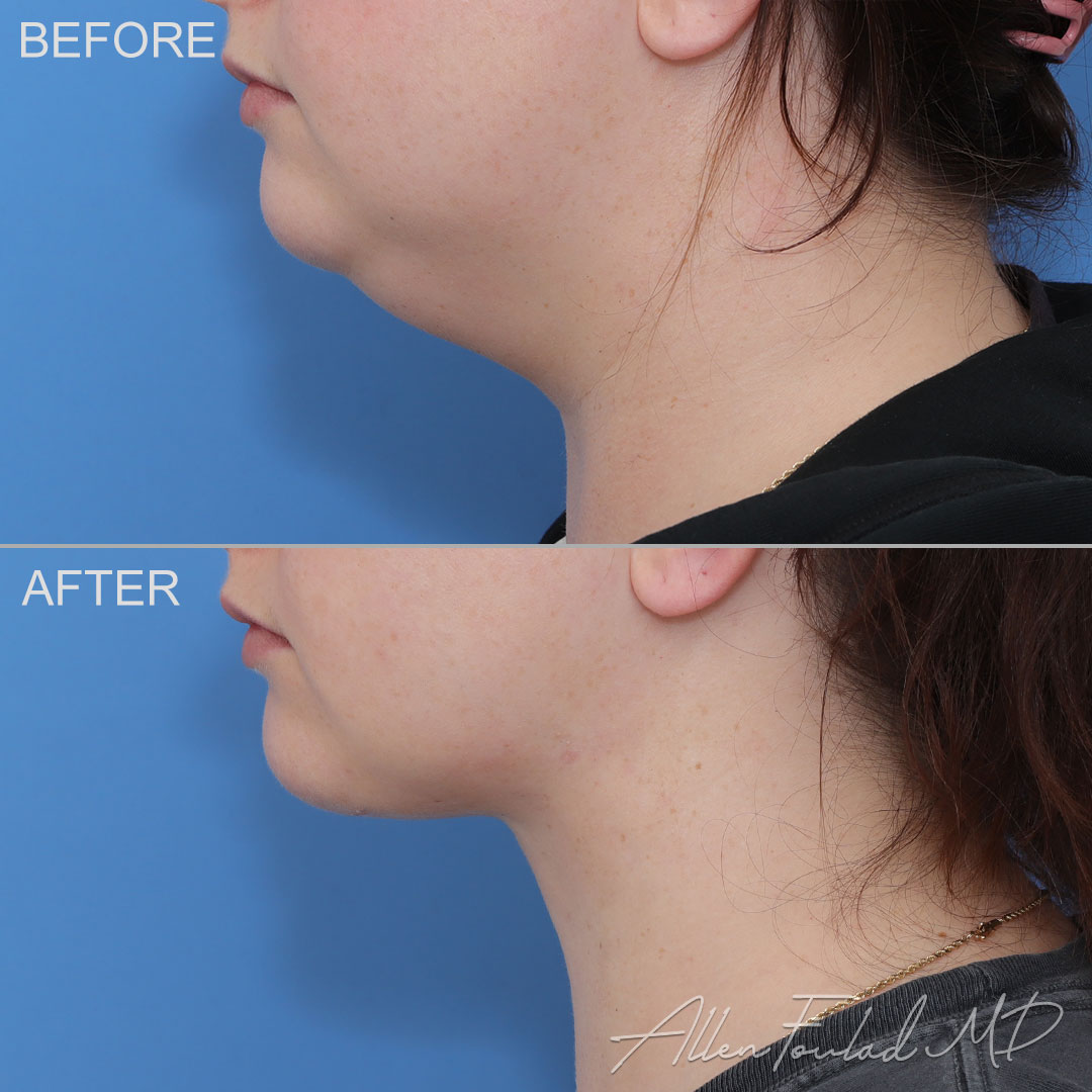 Before and after Minimal Incision Deep Sculpting Neck Lift, on female patient