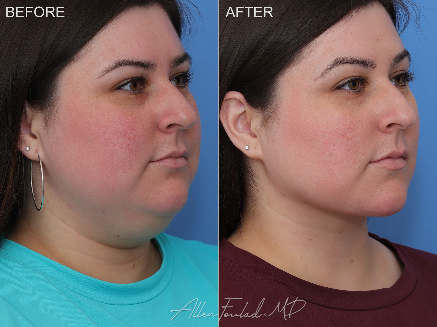 Before and after Minimal Incision Deep Sculpting Neck Lift, on female patient