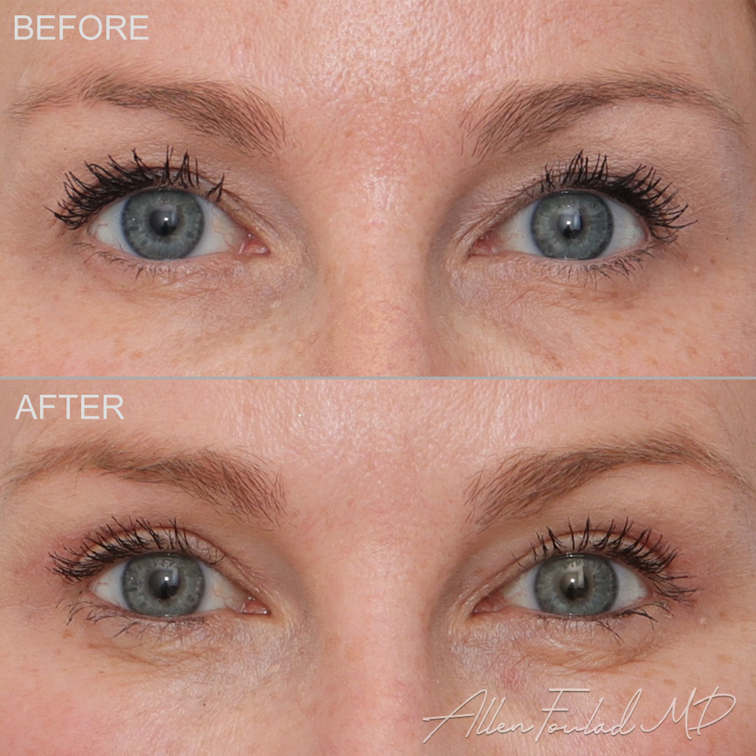 Before and after Upper Eyelid Surgery, on female patient