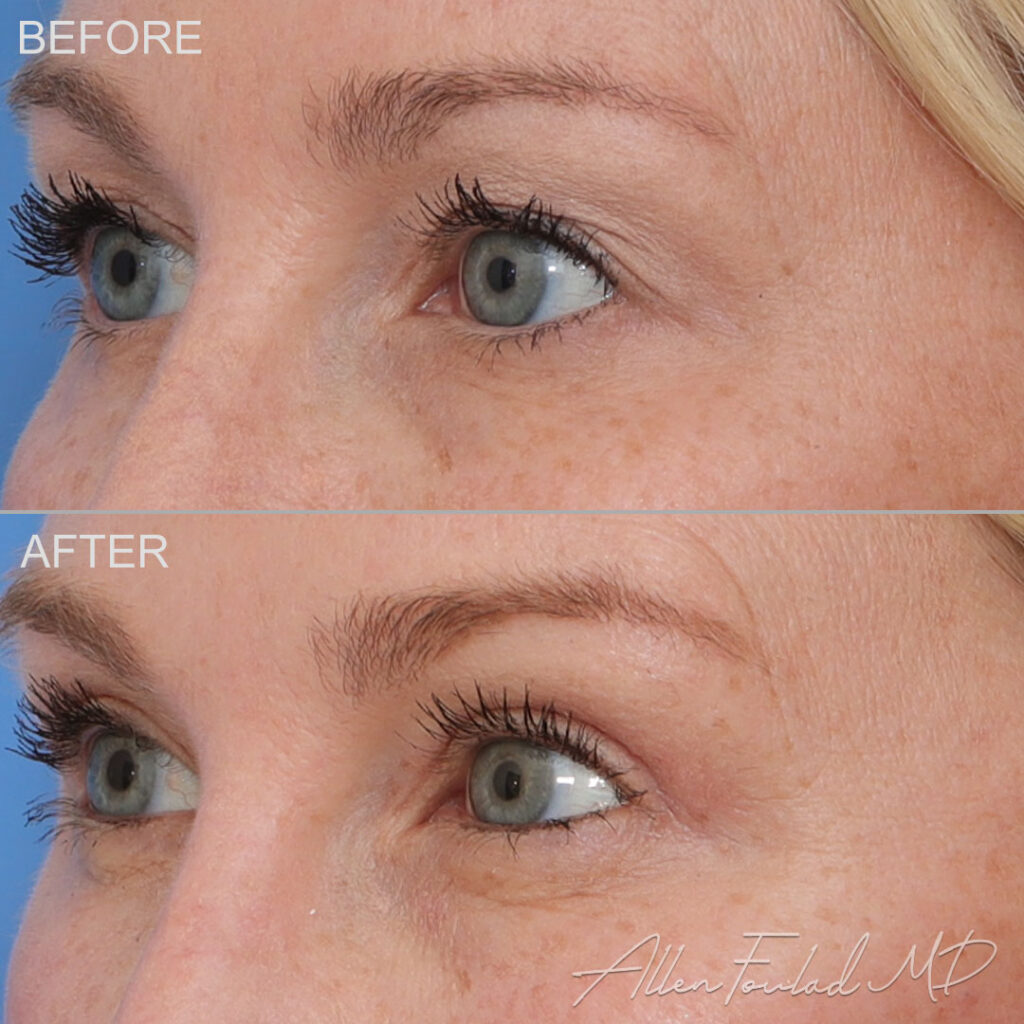 Before and after Upper Eyelid Surgery, on female patient