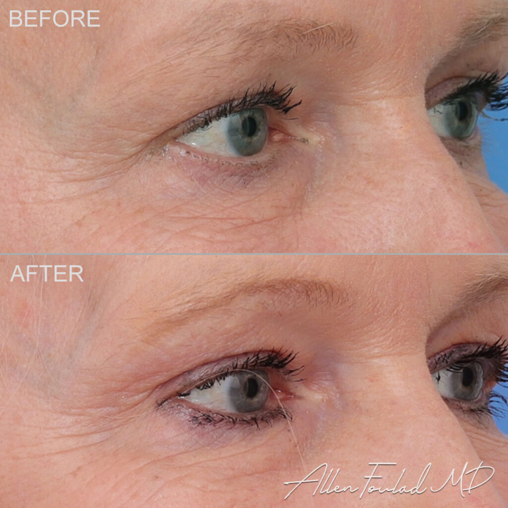 Before and after Lateral Temporal Brow Lift, on female patient