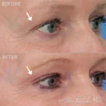 Before & After (id-1080) - Lateral Temporal Brow Lift