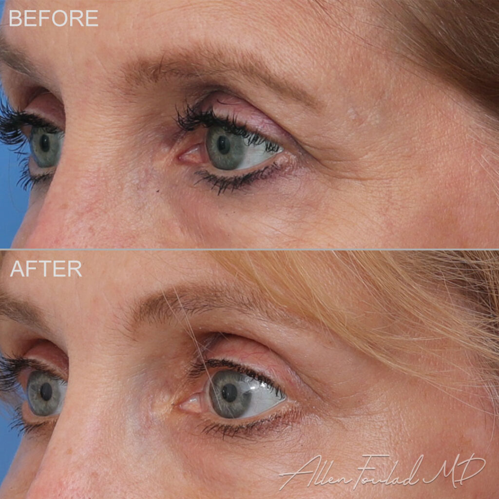 Before and after Lateral Temporal Brow Lift, on female patient