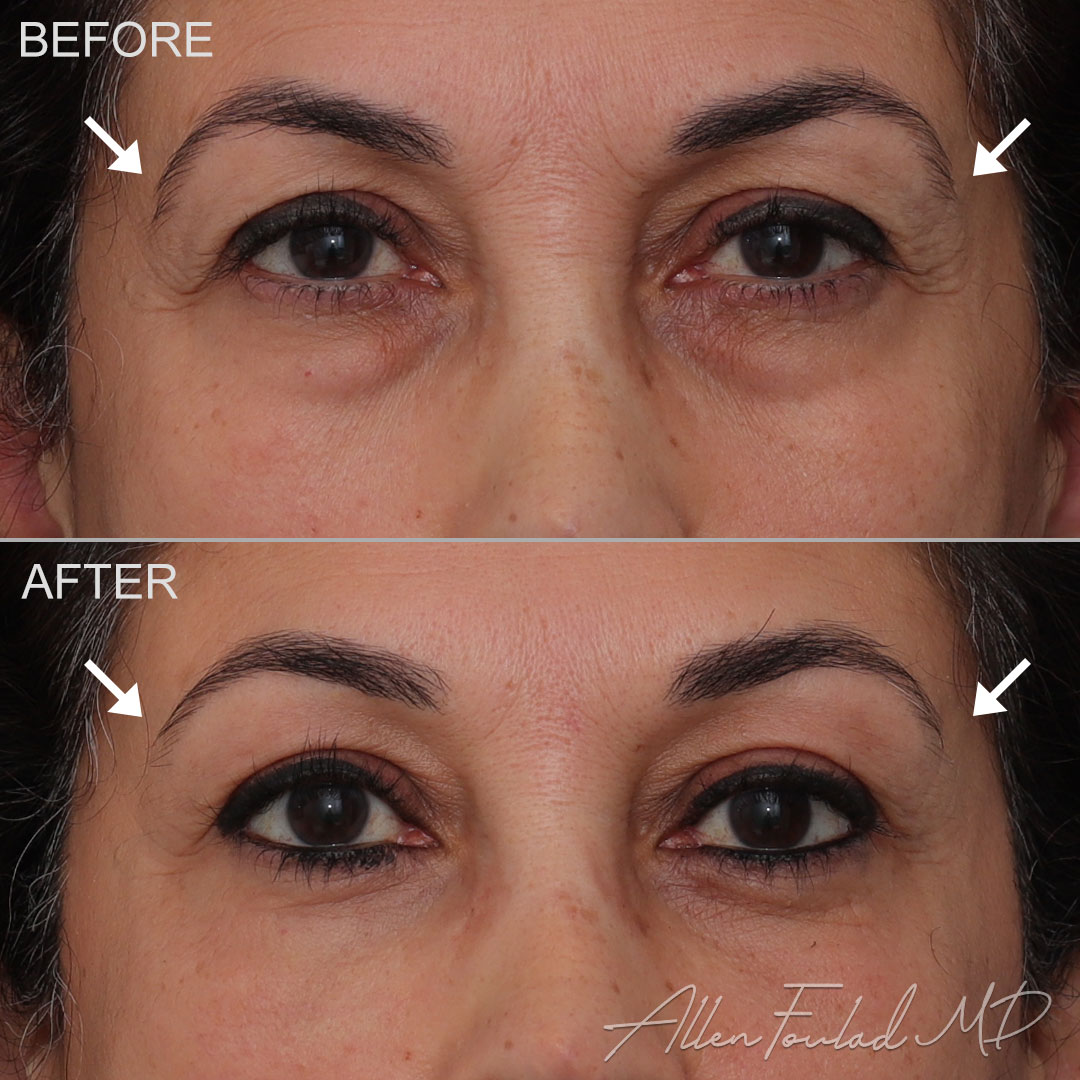 Before and after Lateral Temporal Brow Lift, on female patient