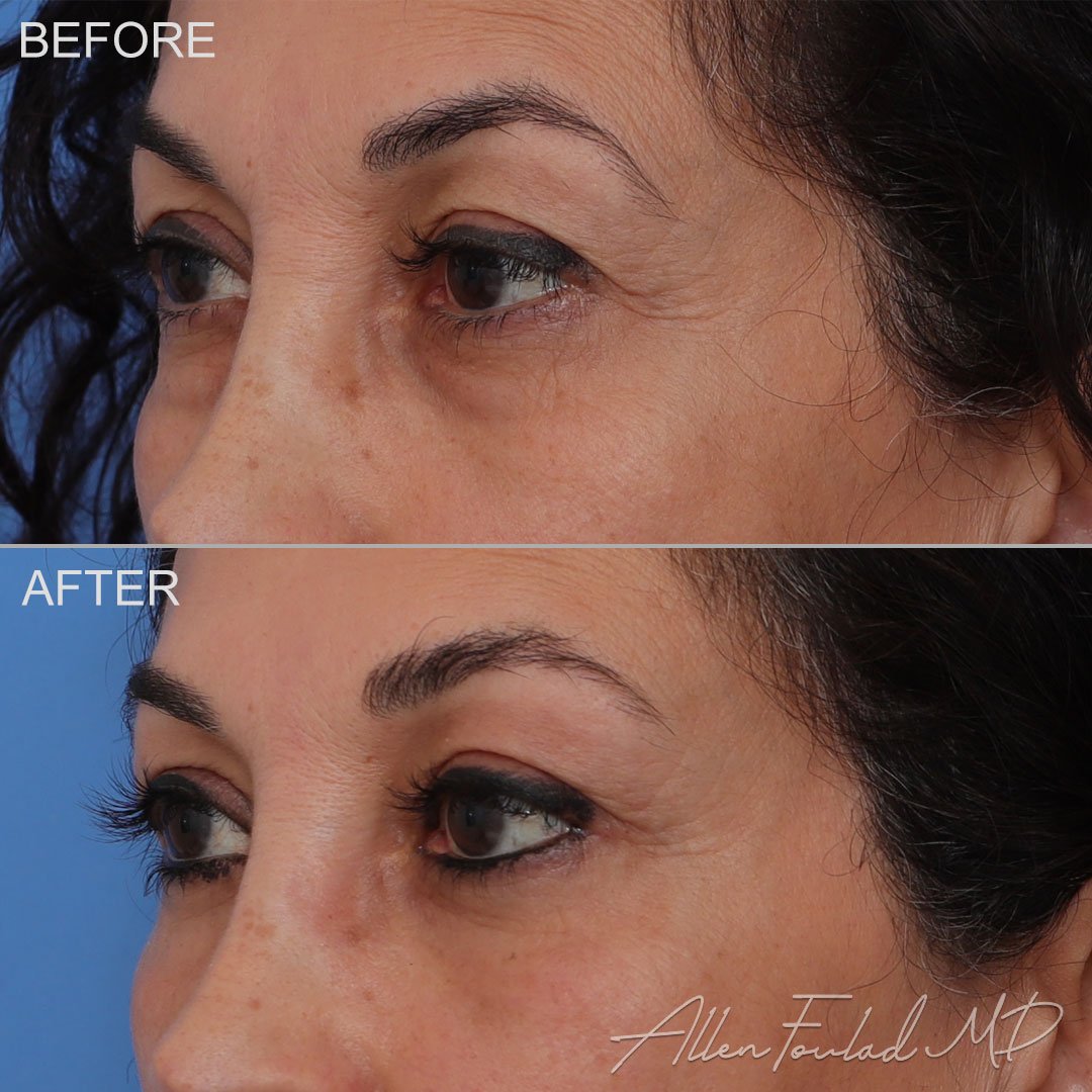 Before and after Lateral Temporal Brow Lift, on female patient