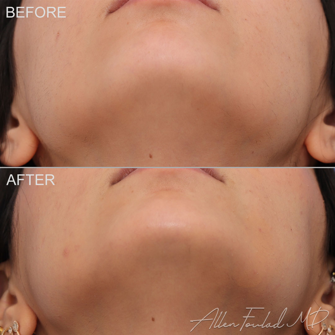 Before and After photo of an extended anatomical chin implant by Allen Foulad, MD