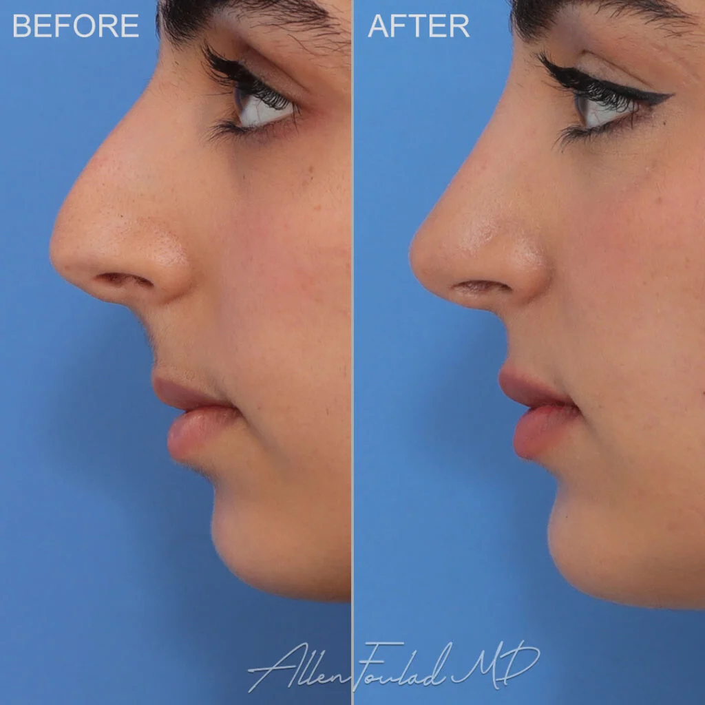 Before and After photo of an extended anatomical chin implant by Allen Foulad, MD Before and After photo of an extended anatomical chin implant by Allen Foulad, MD