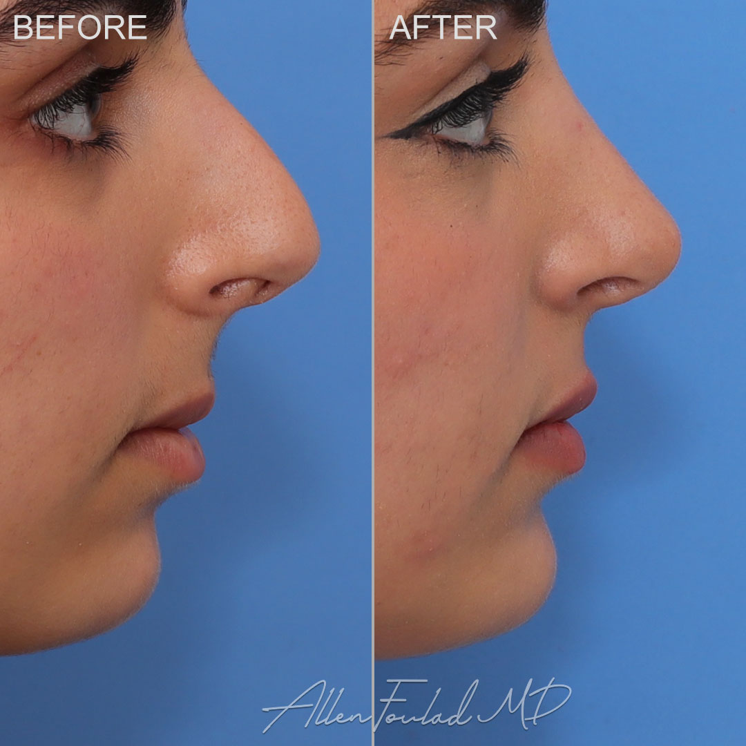 Before and After photo of an extended anatomical chin implant by Allen Foulad, MD