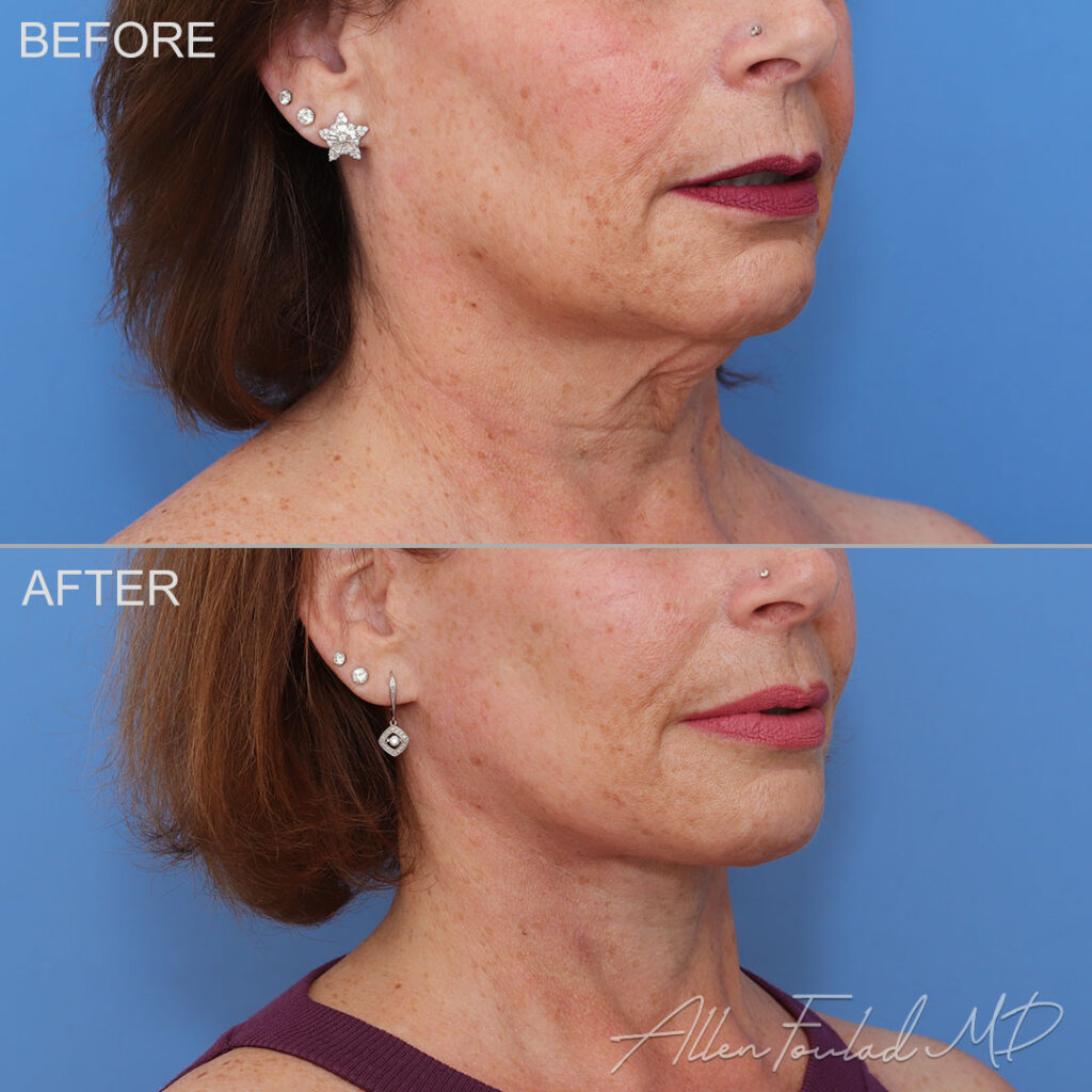 Before and After photo of an extended deep plane facelift and neck lift with platysmaplasty by Allen Foulad, MD