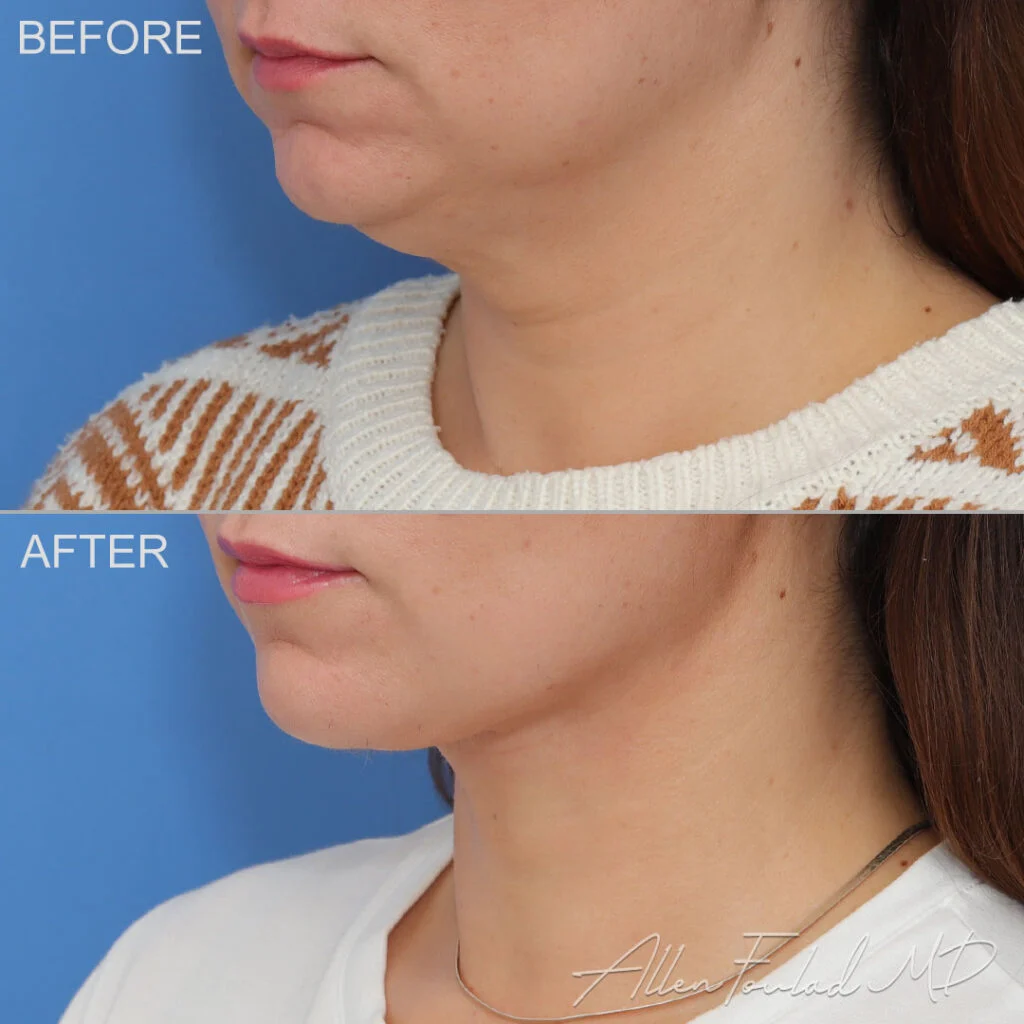 Before and after photo of a patient that received a MIDS Neck Lift Before and after photo of a patient that received a MIDS Neck Lift