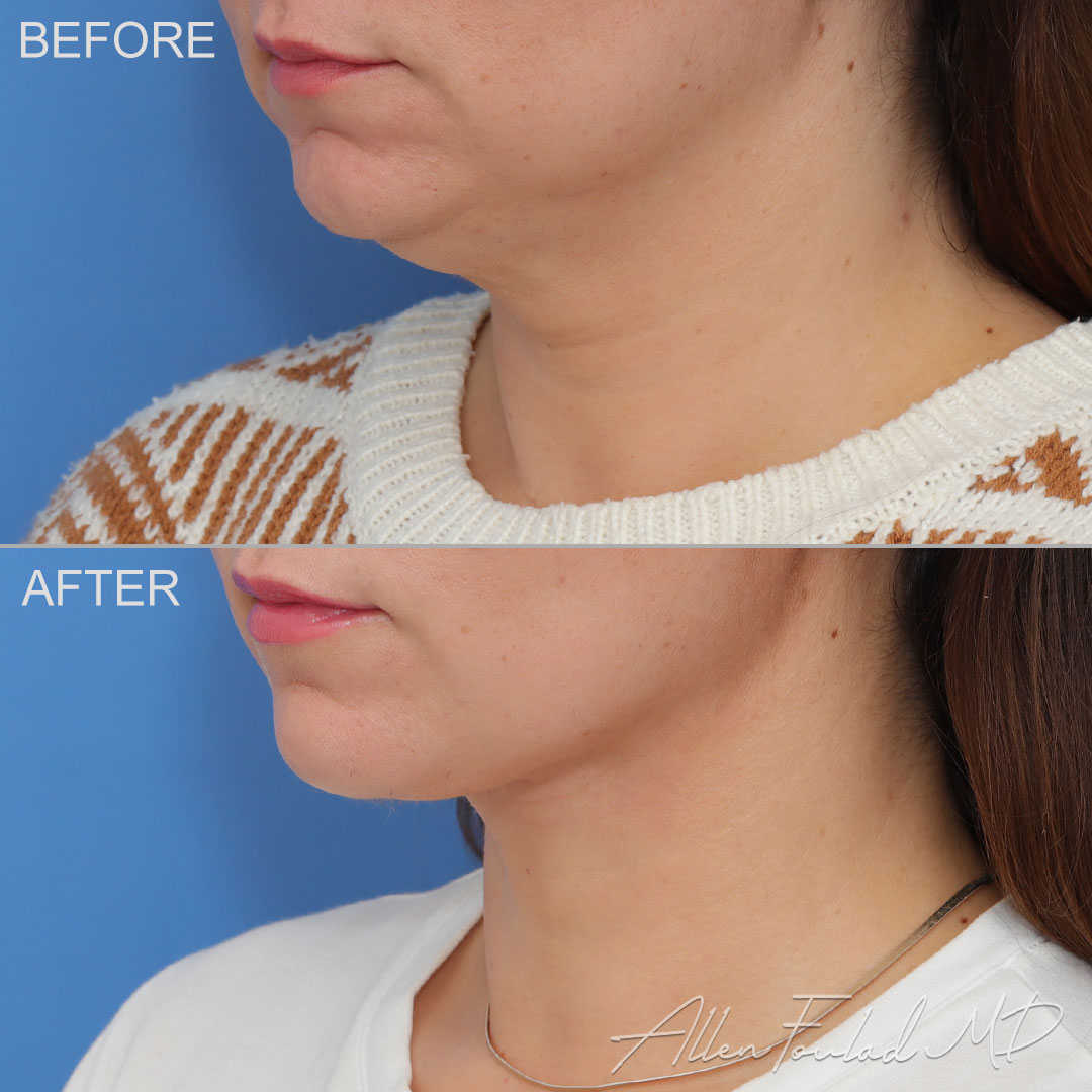 Deep neck sculpting was performed through a small incision under the chin. Superficial fat, deep neck fat, digastric muscles, and submandibular glands were all reduced.