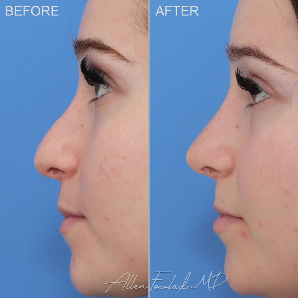 Before and After photo of Revision Rhinoplasty by Allen Foulad, MD