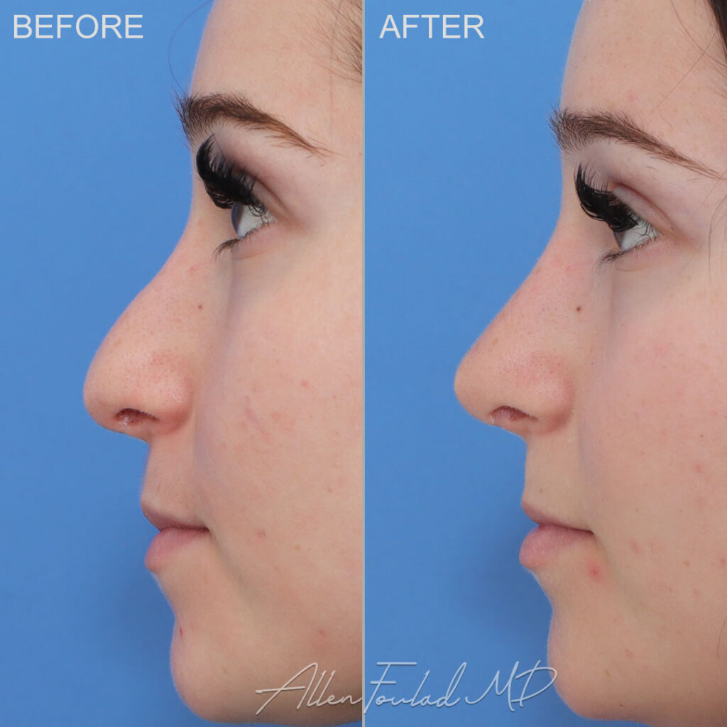 Before and After photo of Revision Rhinoplasty by Allen Foulad, MD Before and After photo of Revision Rhinoplasty by Allen Foulad, MD