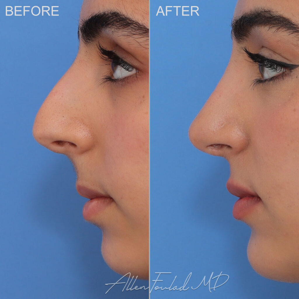 Before and After photo of Rhinoplasty and septoplasty were performed by Allen Foulad, MD Before and After photo of Rhinoplasty and septoplasty were performed to enhance the appearance of the nose and improve breathing.