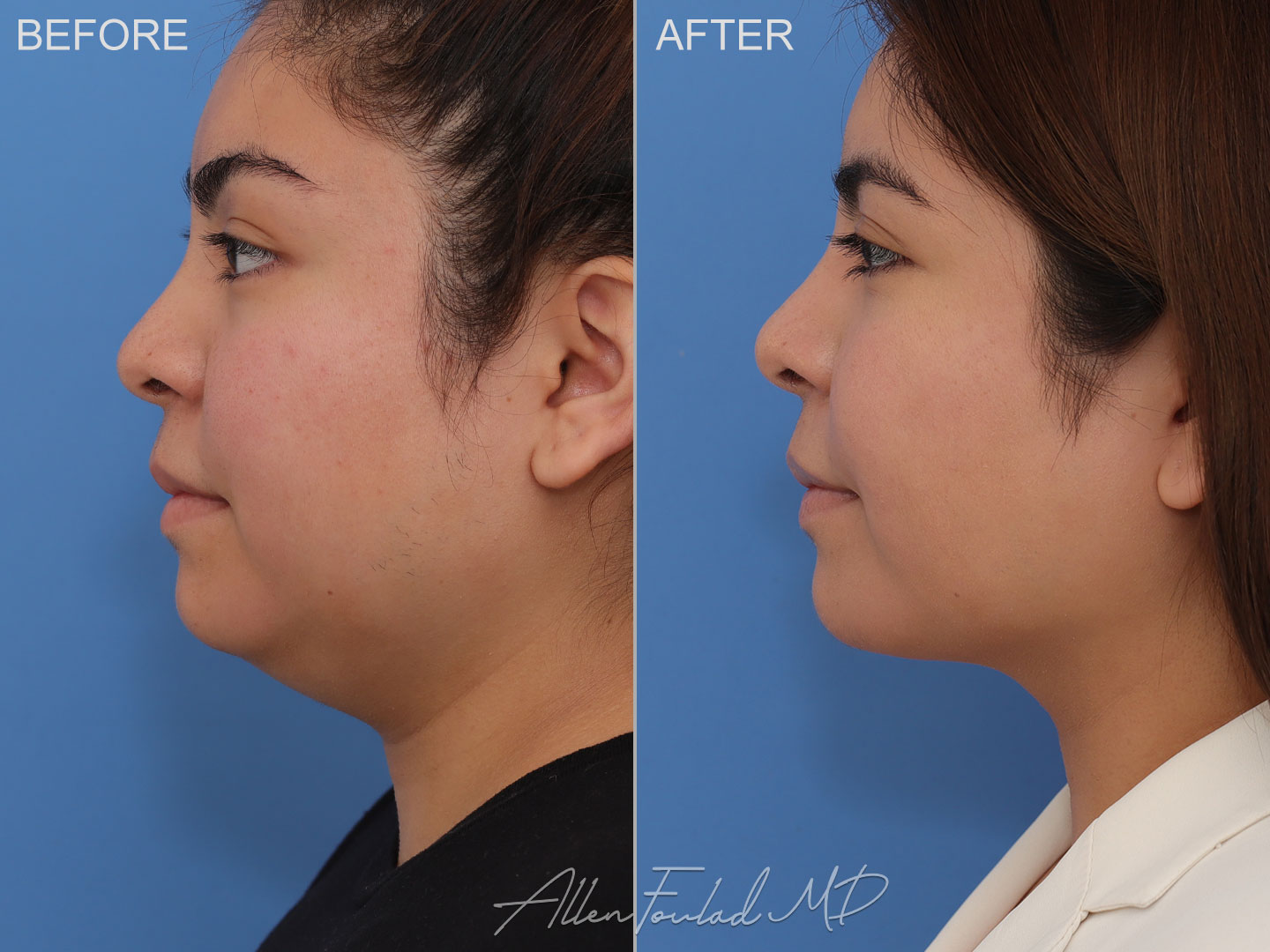 buccal-fat-reduction-1-neck-face-liposuction-lp