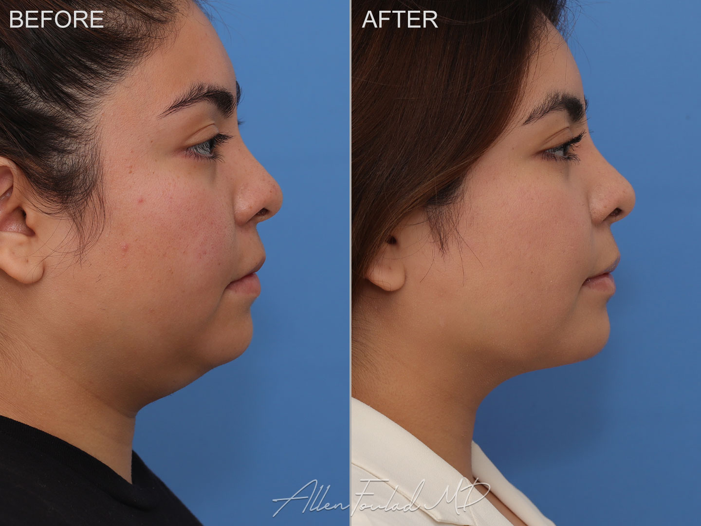 buccal-fat-reduction-1-neck-face-liposuction-rp