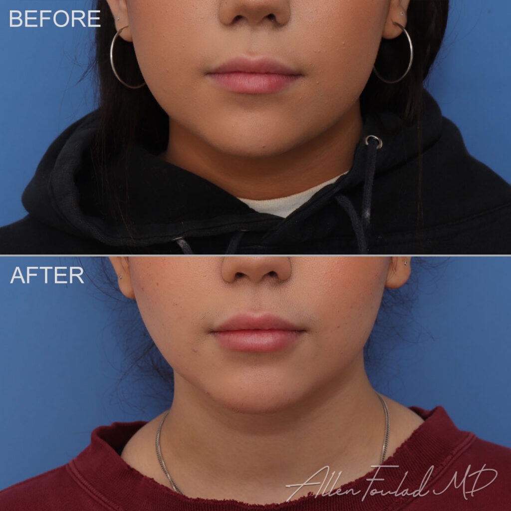 Buccal Fat Removal Before and After Photo by Dr. Foulad in Beverly Hills California