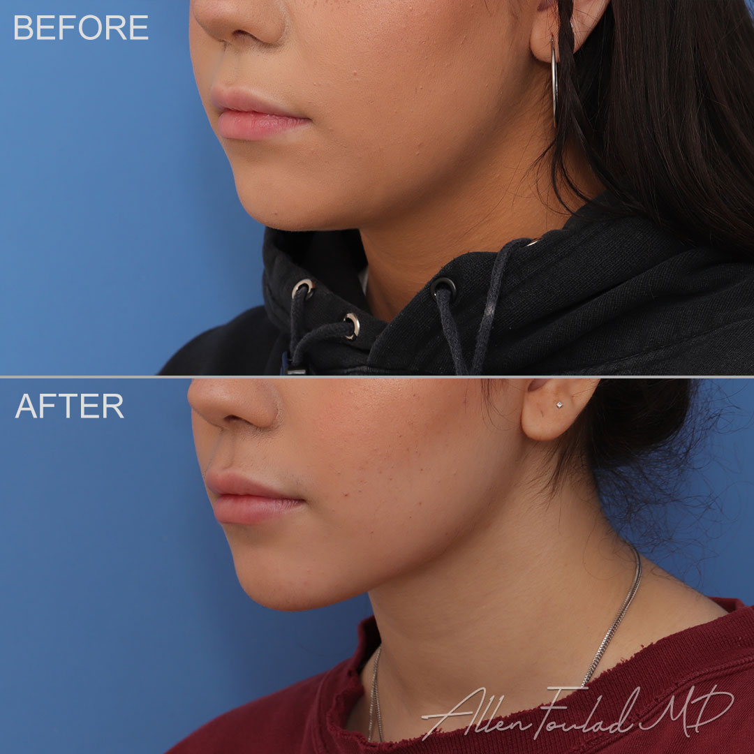 buccal-fat-reduction-4-neck-face-liposuction-facetite-lo